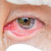 conjuntivitis