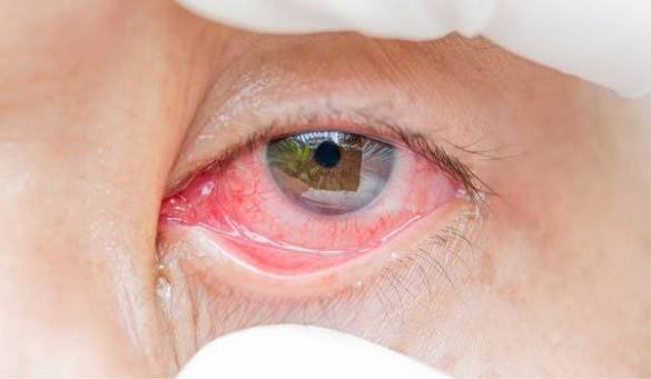 conjuntivitis